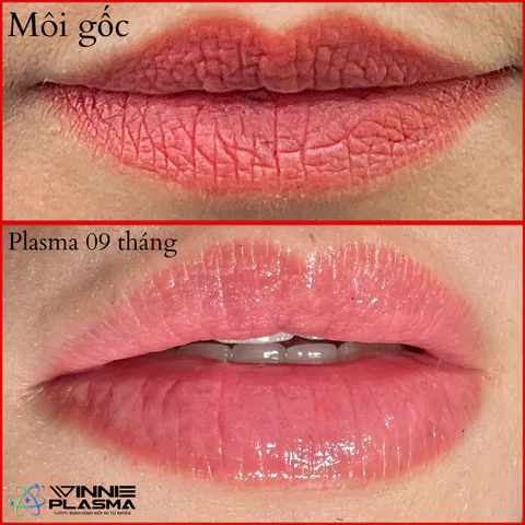 Phun môi tự nhiên — khách hàng thực tế tại Winnie Beauty, ảnh 1