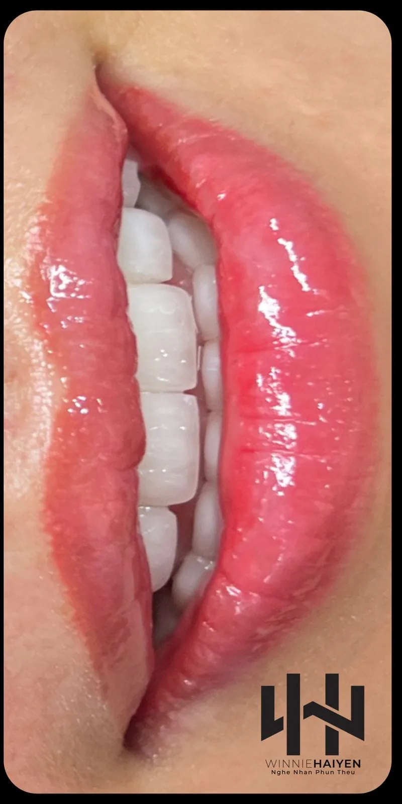 Phun môi tự nhiên — Sau