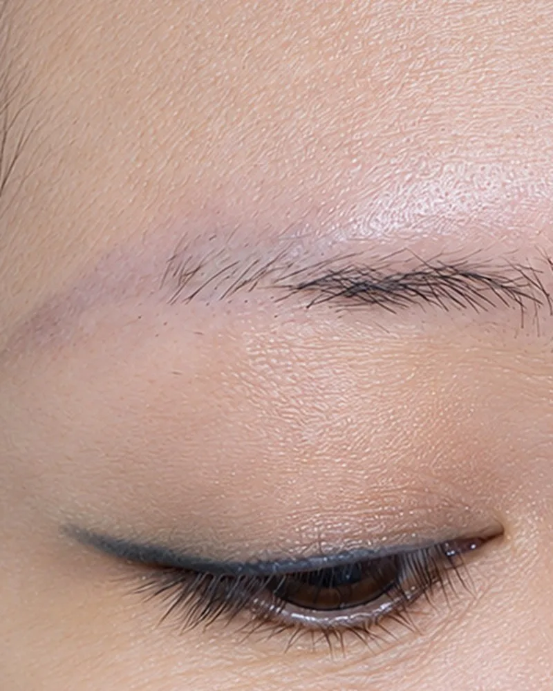 Xóa xăm chân mày bằng laser — Sau