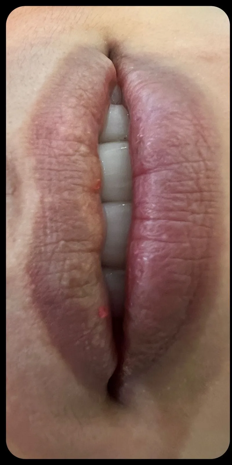 Phun môi tự nhiên — Trước