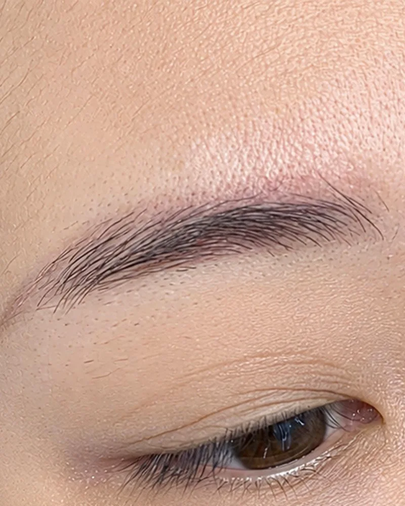 Xóa xăm chân mày bằng laser — Trước