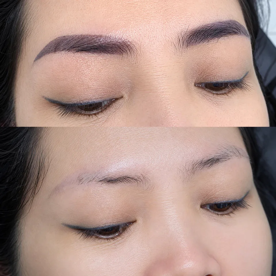 Laser Eyebrow Tattoo Removal — Xóa xăm chân mày bằng laser