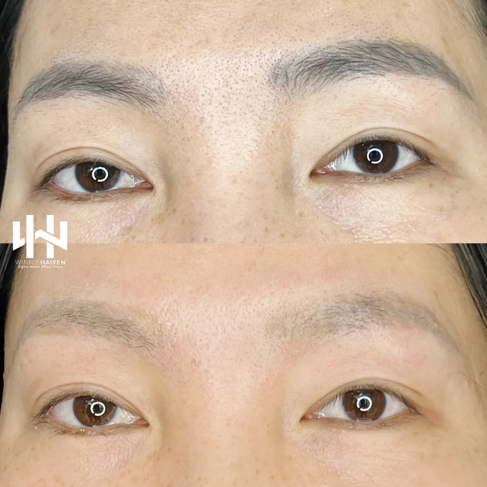 Laser Eyebrow Tattoo Removal — Xóa xăm chân mày bằng laser — Ảnh 4