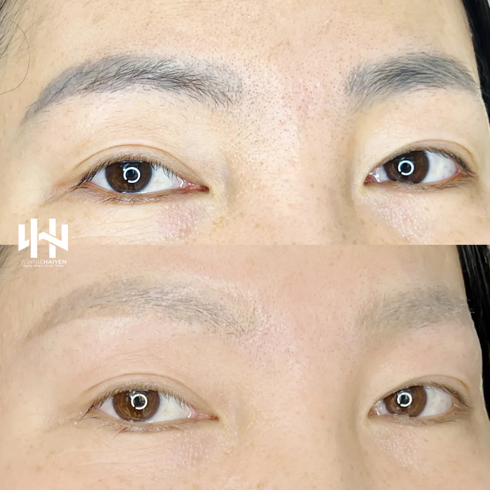 Laser Eyebrow Tattoo Removal — Xóa xăm chân mày bằng laser — Ảnh 3