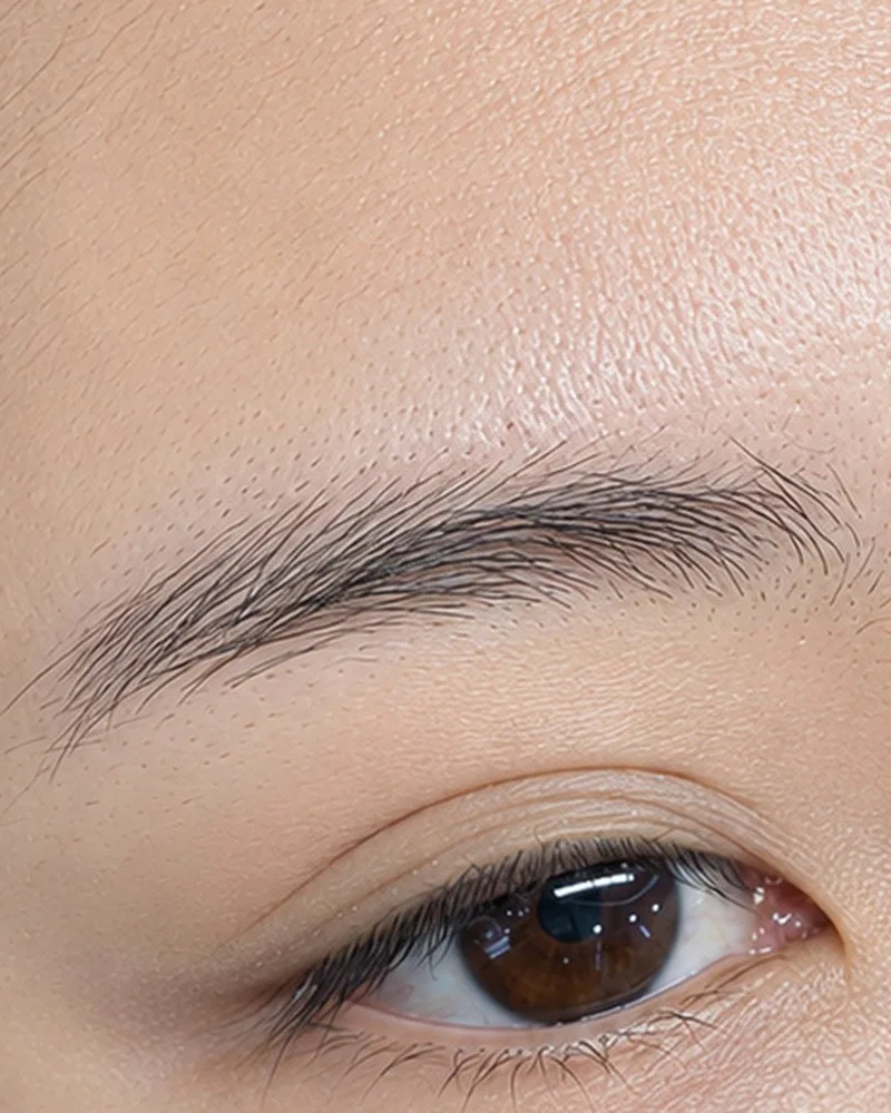 Xóa xăm chân mày bằng laser — Sau